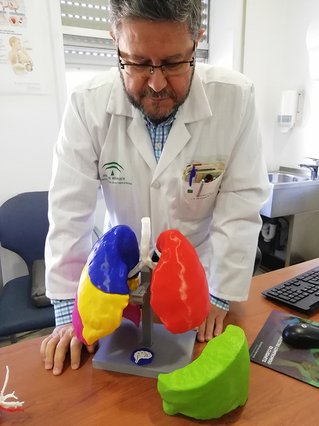 La Unidad de Cirugía Torácica explica a pacientes su intervención con un modelo de impresión 3D